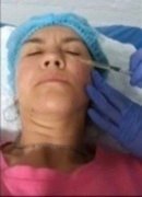 Procedimiento con plasma